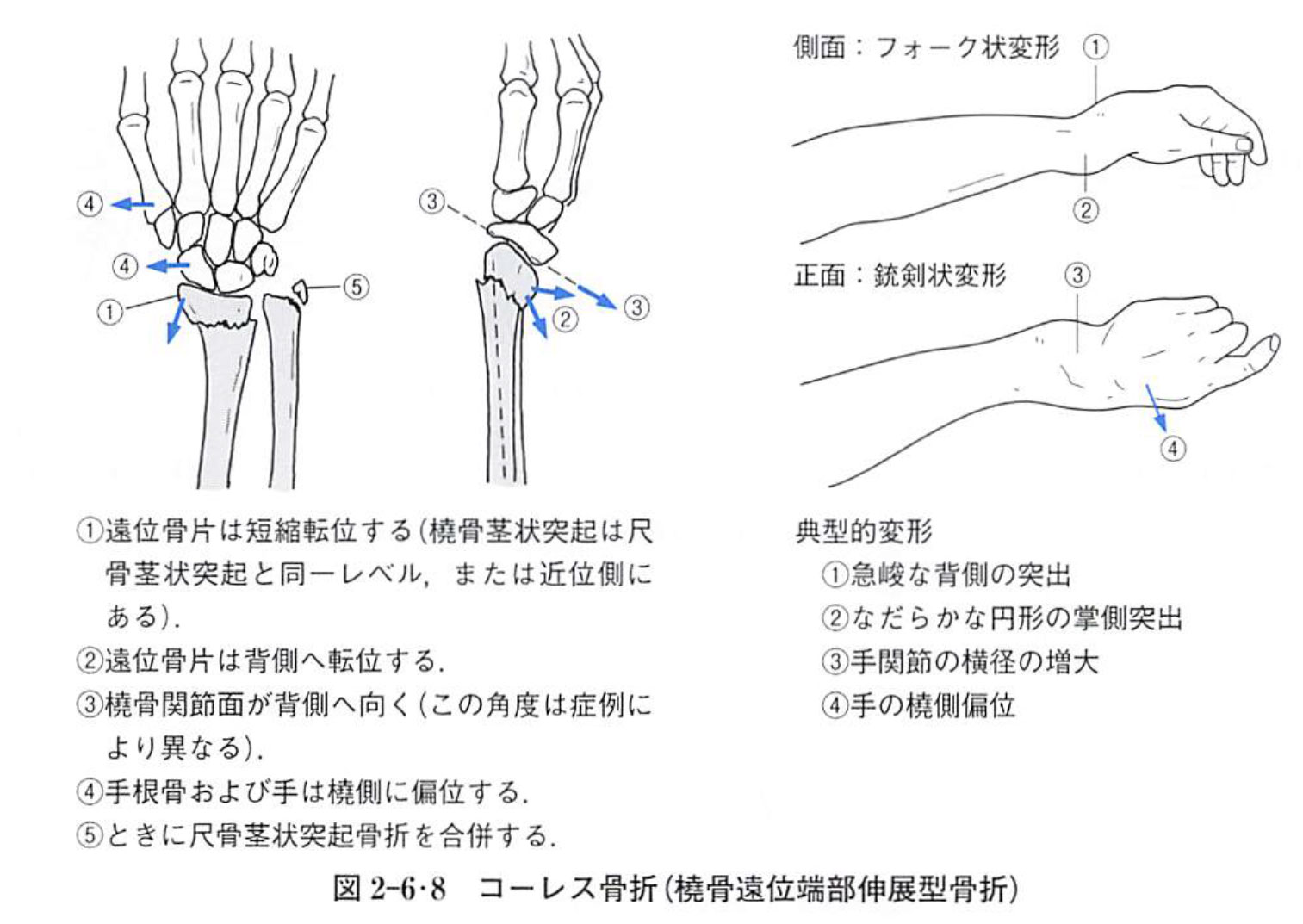 橈骨骨幹部骨折および尺骨骨幹部骨折